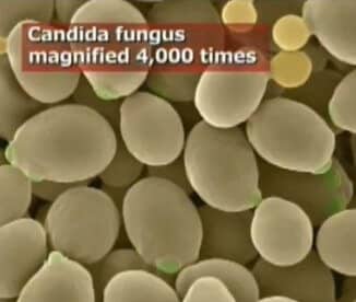 Candida fungus under microscope