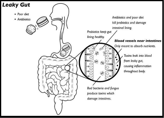 Leaky-Gut-Syndrome_Diagram-w_border