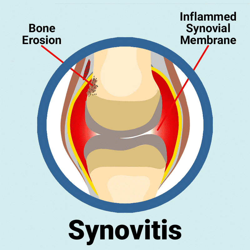 Knee Joint with Inflammed Synovial Packet